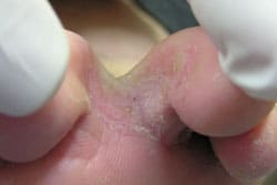 What Can Be Done For Skin Breaks and Cracks Between Toes?