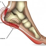 Extreme Heel Pain case study