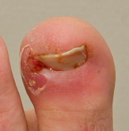 This ingrown toe nail requires treatment by a podiatrist