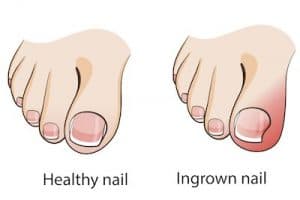 5 hacks to keep ingrown toenails at bay - 1