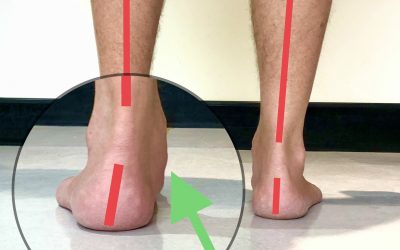 Fallen Arches or Flat Feet and what you need to know