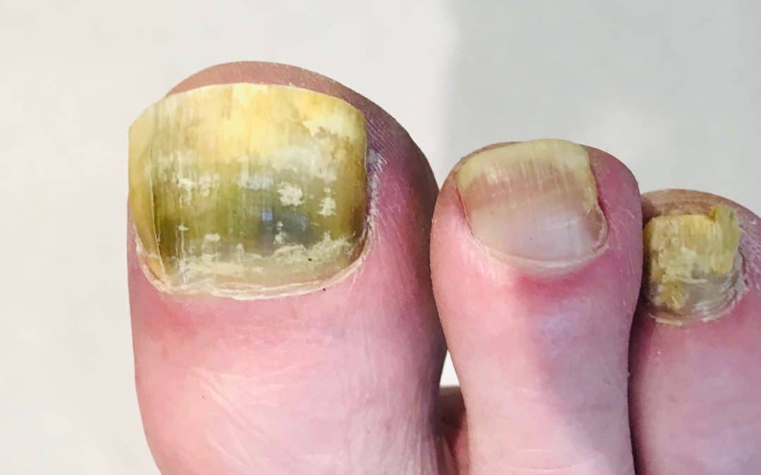Fungal Nail Infection – 6 Top Questions Answered