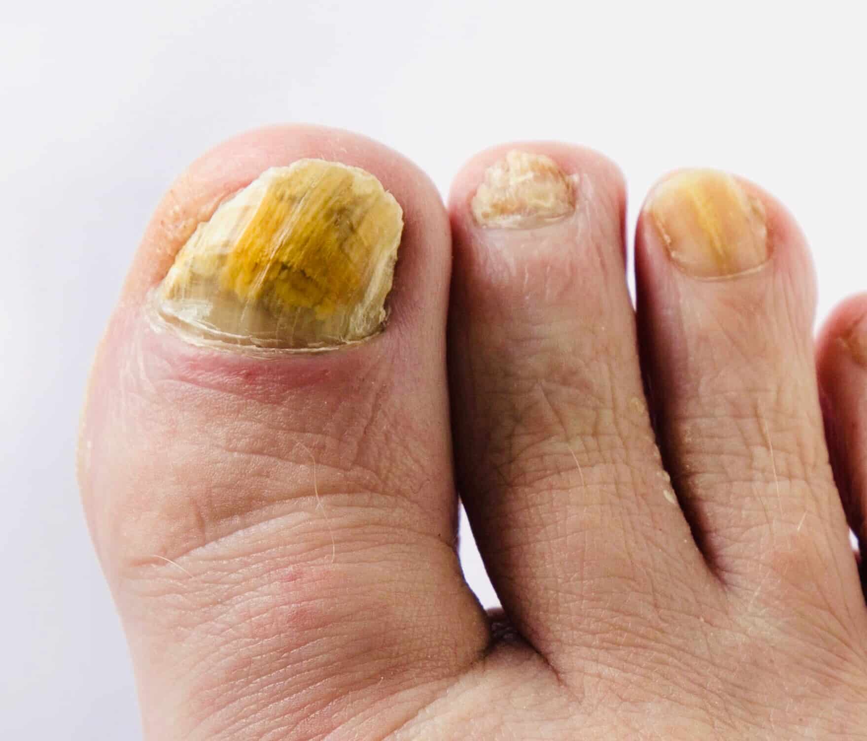 Fungal Nail Infection - Heavy