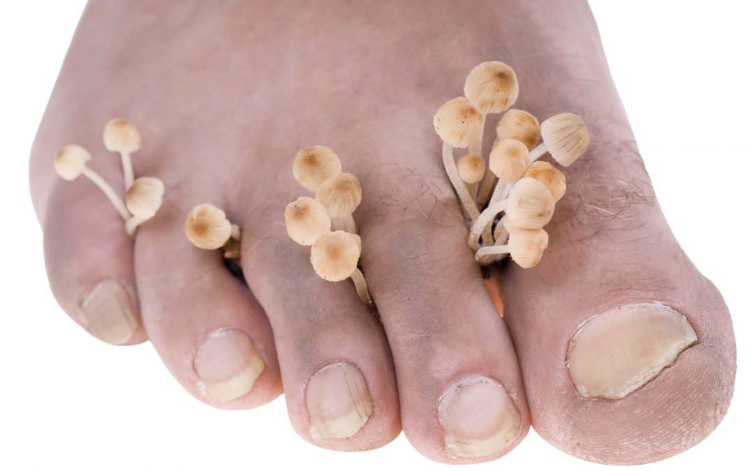 Fungal Nail Infection – 5 questions to ask anyone providing Fungal nail treatment