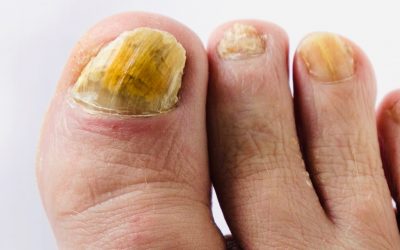 Fungal Nail Laser Therapy Mistakes Therapists Make