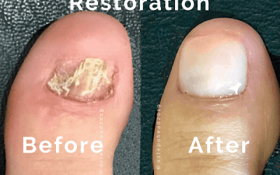 Fungal Nail Restoration