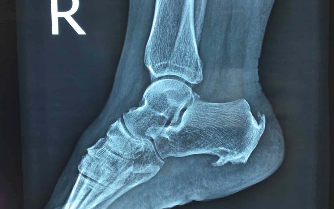 Heel Pain X-ray YES or NO by Dr Brenden Brown – Podiatrist