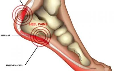 Heel spur and Why you don’t have one by Dr Brenden Brown – Podiatrist