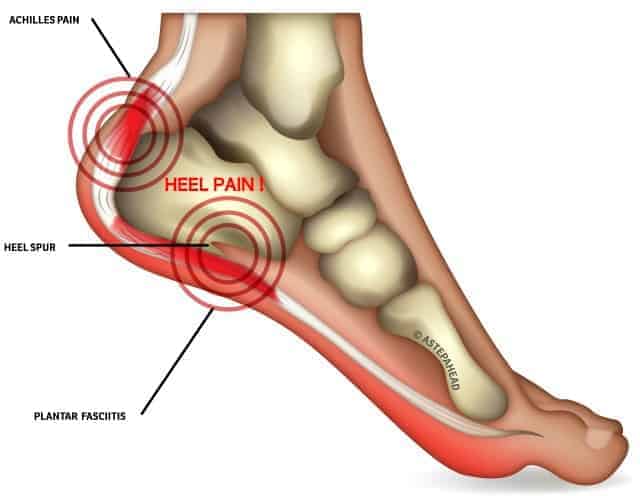 Heel spur and Why you don’t have one by Dr Brenden Brown – Podiatrist
