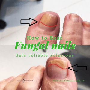 How Tanya beat unsightly Nail Fungus - 1