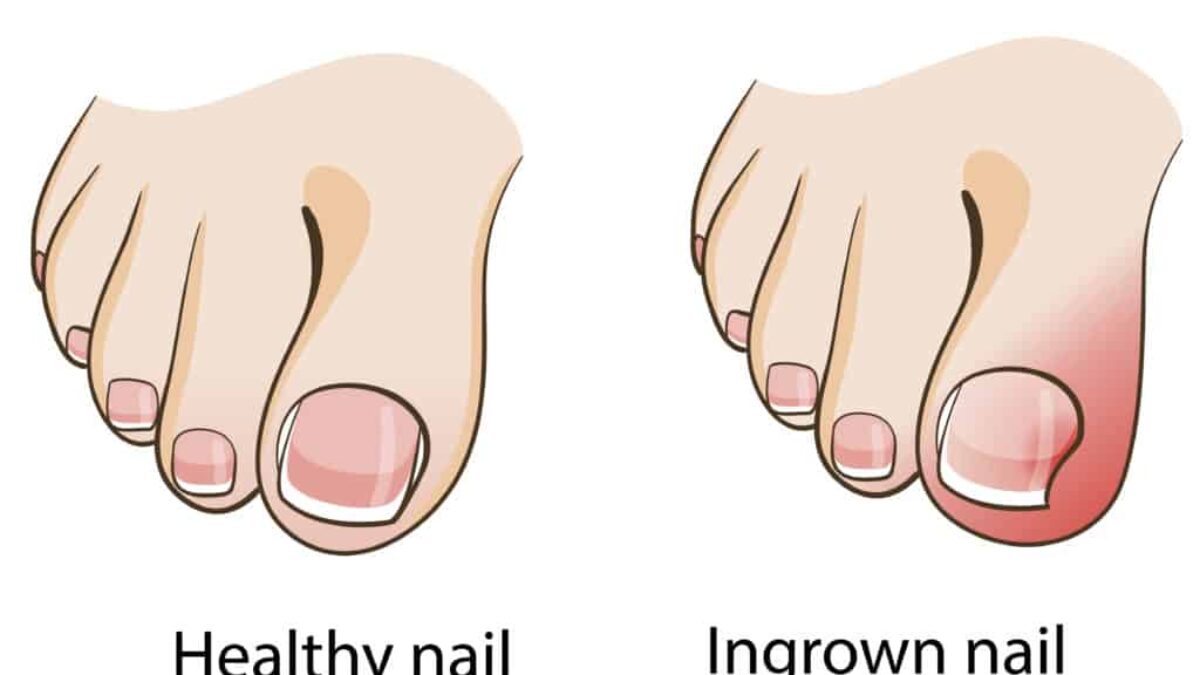 Cracked Heels Home Remedy: This DIY Home Remedy for Cracked Heels Works  Like a Charm! | - Times of India