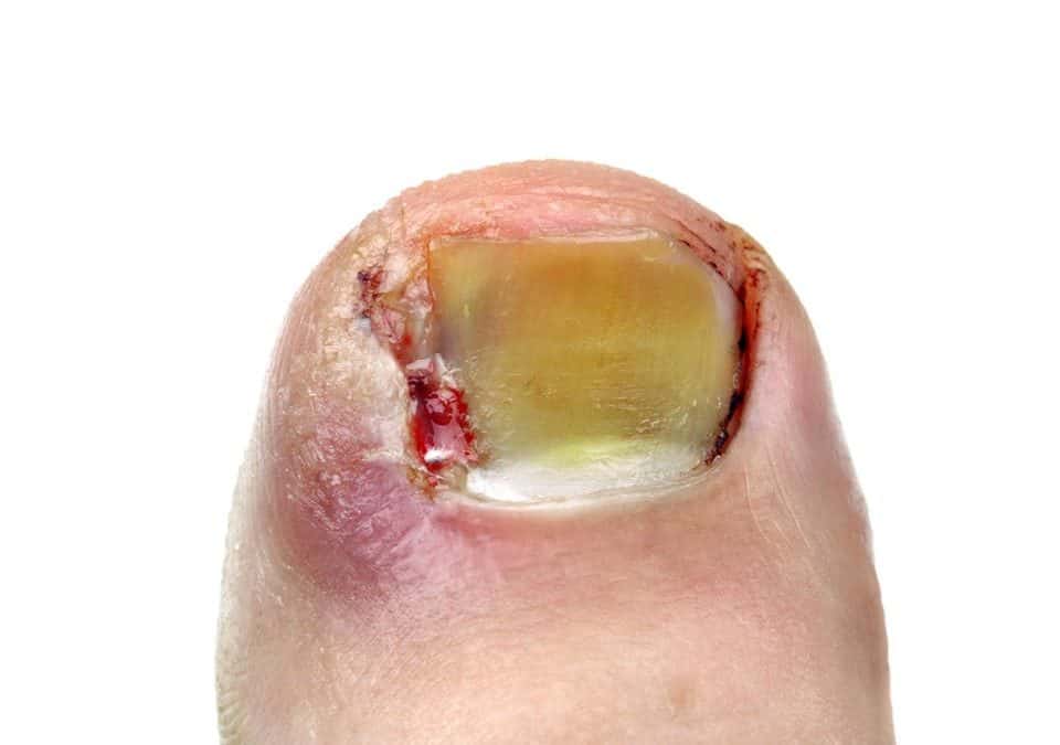 Ingrown toenails Ouchi Mumma these can hurt!