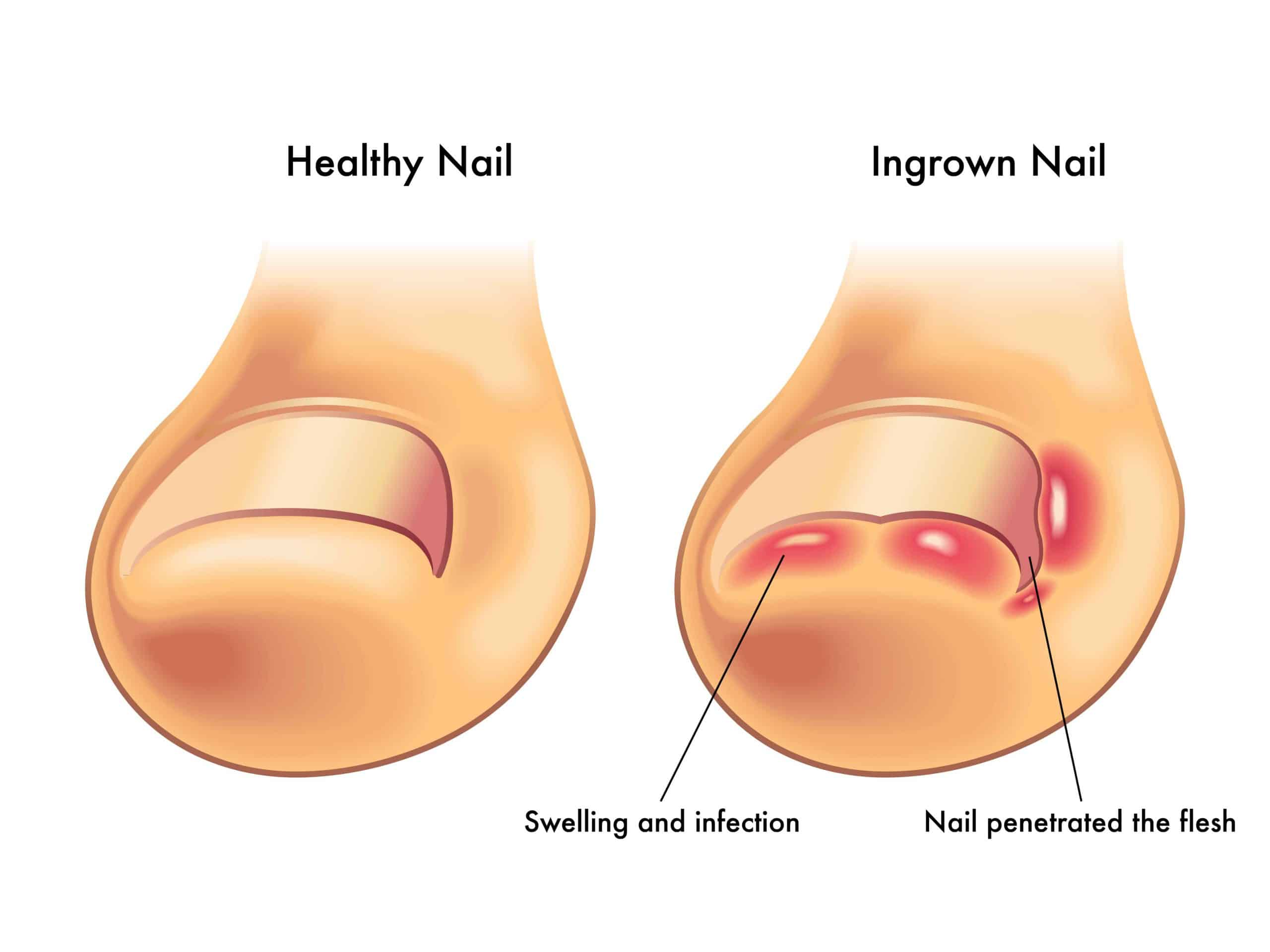 Ingrown Toenails Do I Need Surgery A Step Ahead Foot Ankle Care