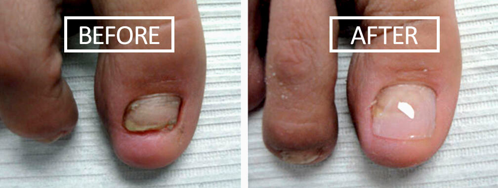 A makeover for your nails: Keryflex Nail Restoration | Richmond Podiatry