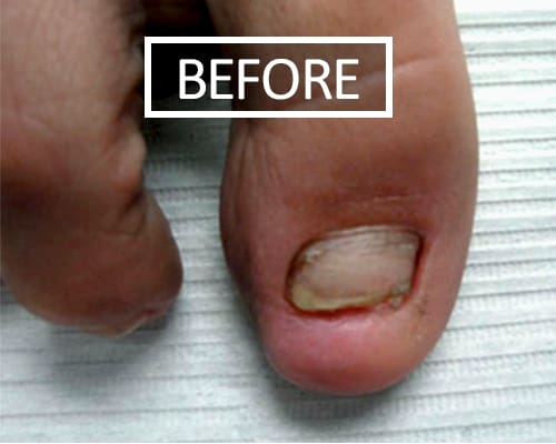 KeryFlex nail restoration | Talaria Podiatrist
