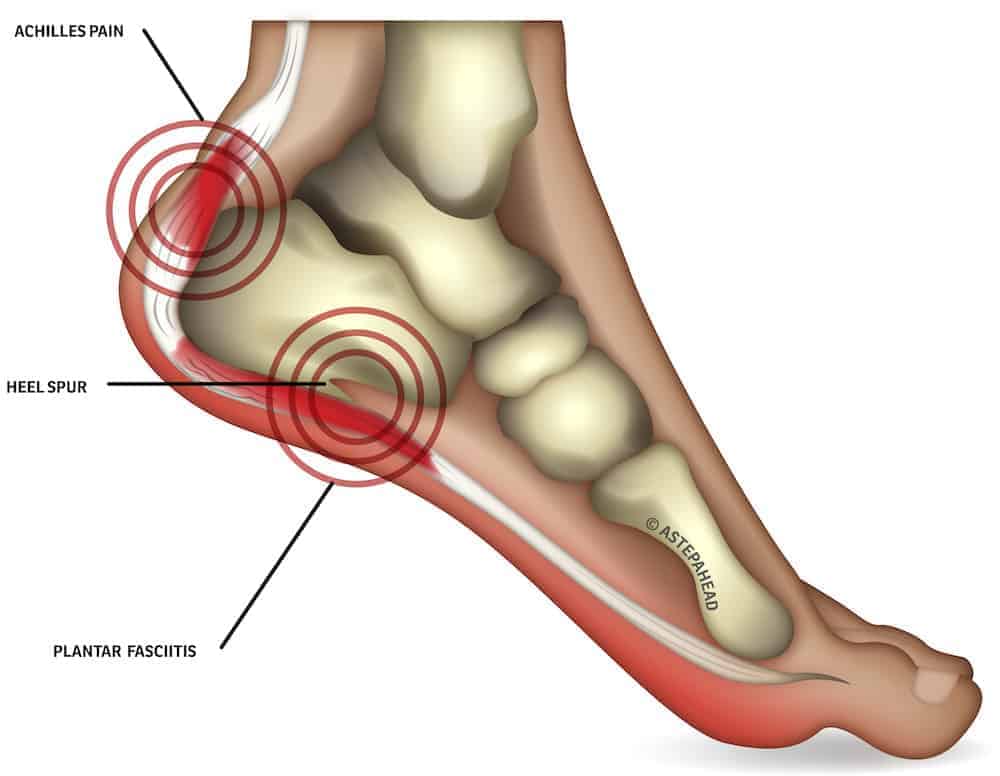 Shockwave Therapy Helps Heel Pain Plantar Fasciitis